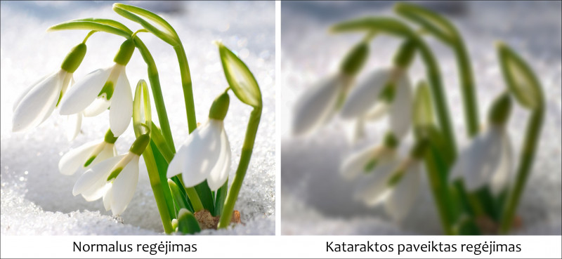 Katarakta – liga, kelianti pavojų regėjimui