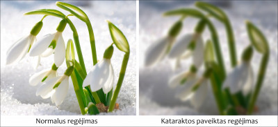 Katarakta – liga, kelianti pavojų regėjimui