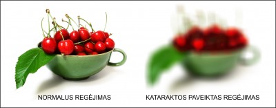 Sergant katarakta delsti negalima