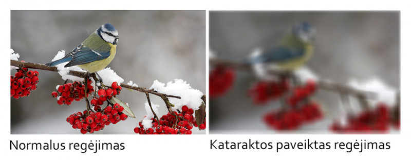 Katarakta: simptomai ir gydymas