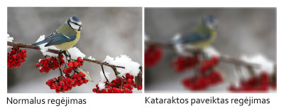 Katarakta: simptomai ir gydymas