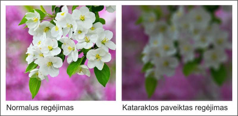 Negydant kataraktos, gresia aklumas
