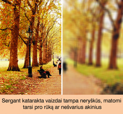 Katarakta – akių liga, progresuojanti iki aklumo